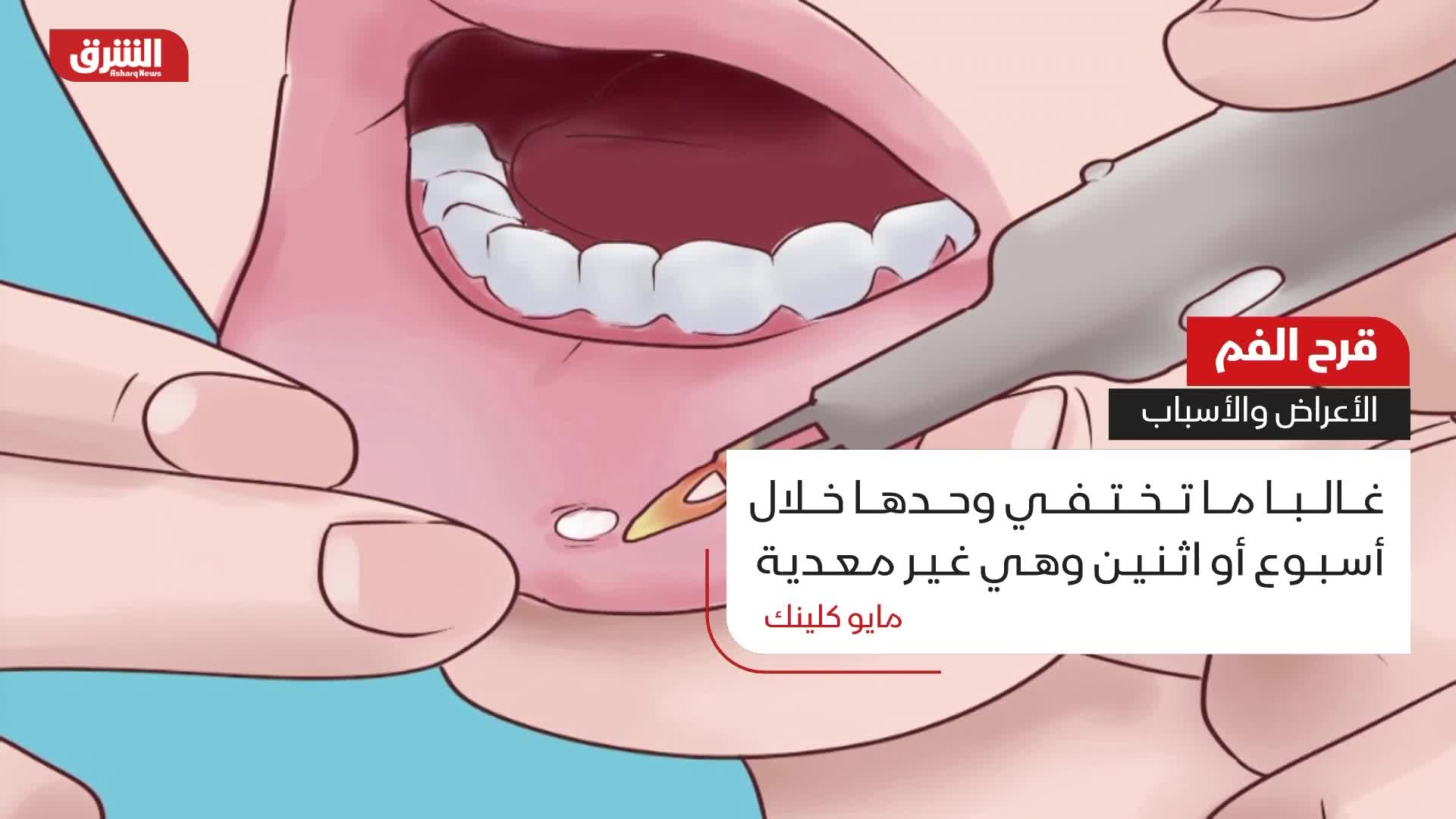 علامات قرحة الرحم